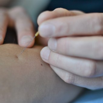 dry needling